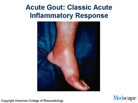 Treating Chronic Gout The Challenges Of Lowering Serum Urate Levels