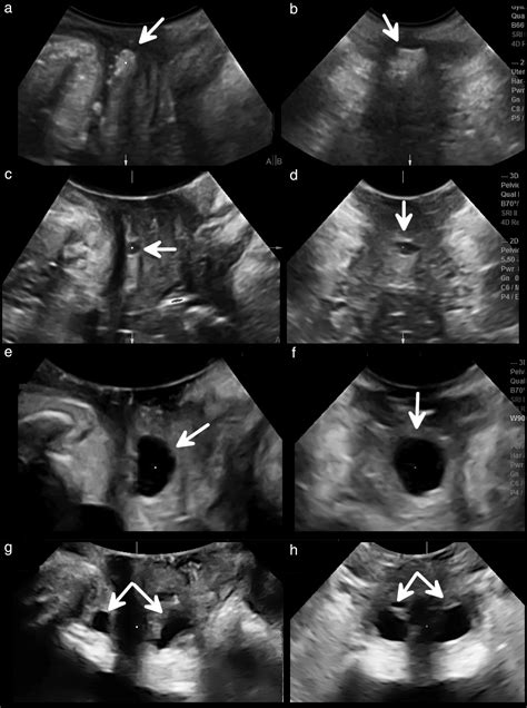 Translabial Ultrasound Imaging Of Urethral Diverticula Gillor 2019
