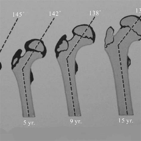 Normal Mean Angle Of Femoral Neck Shaft According To Age 20