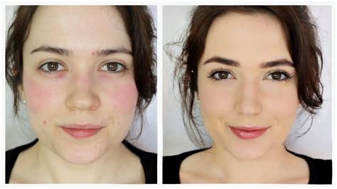 How To Get Rid Of Redness Without Makeup Tutorial Pics