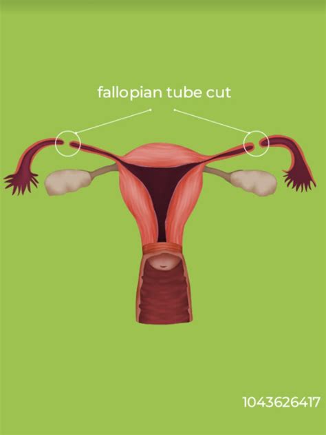 Female Voluntary Surgical Contraception Bilateral Tubal Ligation