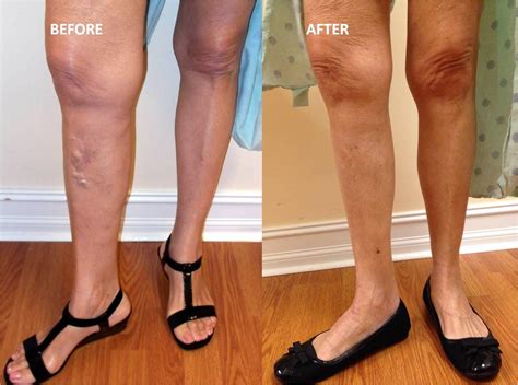 What Are The New Treatments For Varicose Veins