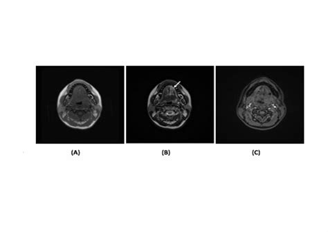 Role Of Dynamic Contrast Enhanced Magnetic Resonance Imaging In The