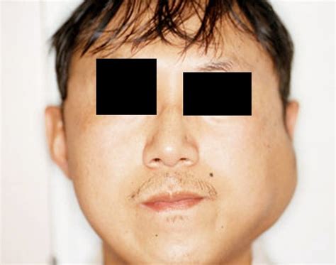 Parotid Gland Swelling Symptoms Pictures Causes Treatment 2021