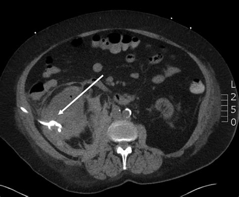 Pigtail Drain In The Hemorrhagic Cyst From The Right Native Kidney