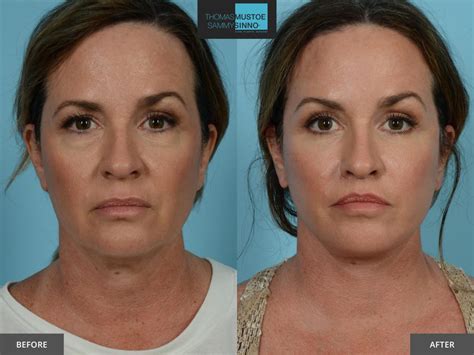Facelift Before And After Photos That Prove Just How Natural Todays Results Look Tlkm