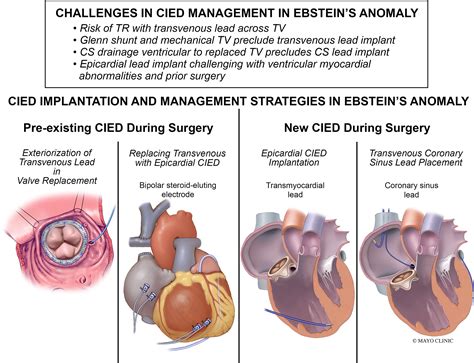 Cardiac Implantable Electronic Devices In Ebstein Anomaly Management