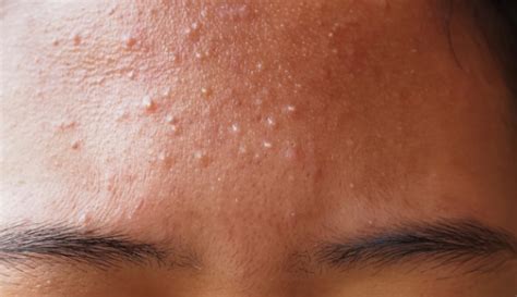 Perbedaan Fungal Acne Dan Bruntusan Mengenal Gejala Penyebab Dan Pengobatannya