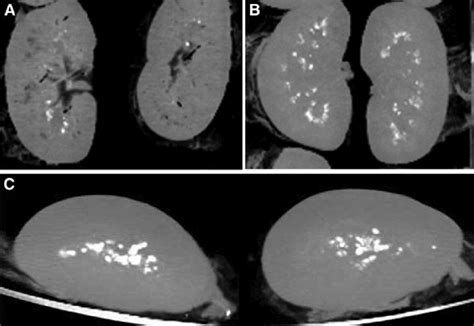 Ct Scans Showing Calcifications In The Renal Collecting System Of A