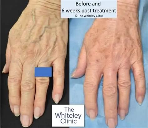 Hand Vein Removal The Whiteley Clinic