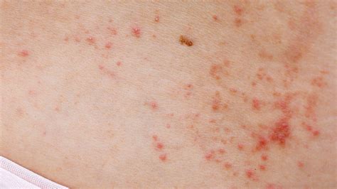 What Do Red Itchy Spots Mean A Dermatologist Named The Reasons