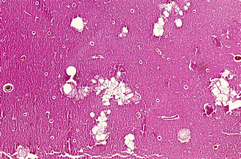 Purulent Meningitis Light Micrograph Stock Image C0511570