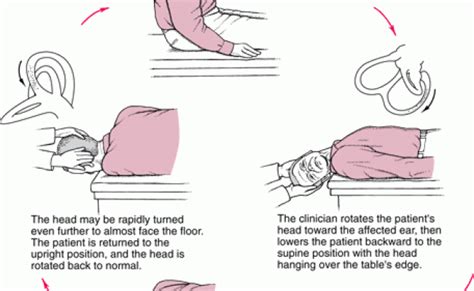 How To Perform The Epley Maneuver At Home For Bppv Otosection