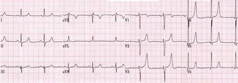 Peaked T Waves Wikidoc