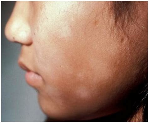 Vảy Phấn Trắngpityriasis Alba