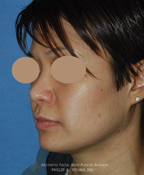 Asian Plastic Surgery Before And After Photos Seattle Bellevue