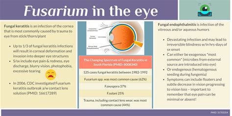 Fusarium Eye Infections Keratitis And Endophthalmitis Fungal