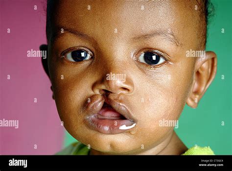 African Baby Boy Cleft Cleft Lip Stock Photo Alamy