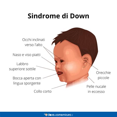 Sindrome di Down Trisomia 21 cos è Cause e anomalia dei cromosomi