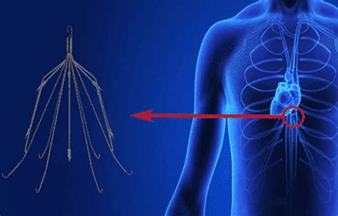 Use Of Inferior Vena Cava Filters For Treatment Of Vte Sir Guideline
