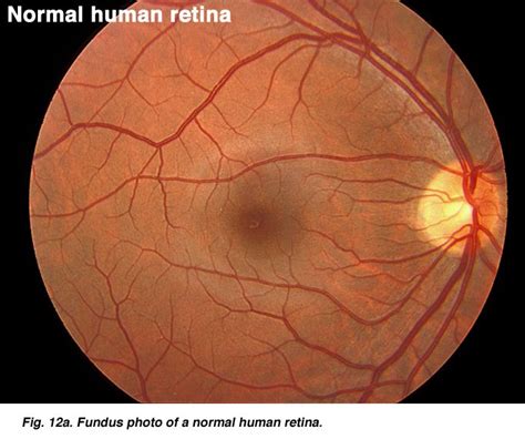 Normal Retina Eyewear Pinterest Optometry