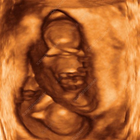 10 Week Twin Foetuses 3 D Ultrasound Stock Image P6800762