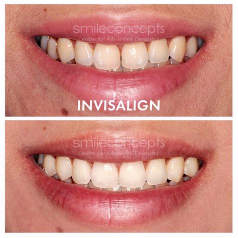 Do All Celebrities Have Veneers Your Personal Guide On Hollywood Smile
