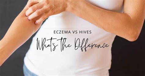 Eczema Vs Hives Whats The Difference Enticare Ent Doctors Arizona