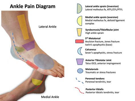 Foot Pain Identifier Chart Tendon