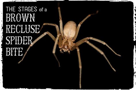 The black widow spider bite symptoms are a result of the venom which contains protein that can considerably influence the nervous system of the bitten individual. Brown Recluse Bite: Pictures, Stages, Symptoms & Treatment