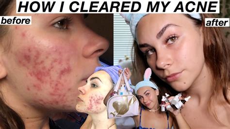 How I Cleared My Skin And Acne Scars Fungal And Hormonal Cystic Acne