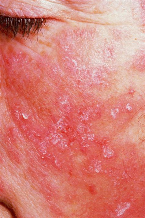 Rash Of Systemic Lupus Erythematosus On Cheek Photograph By Science