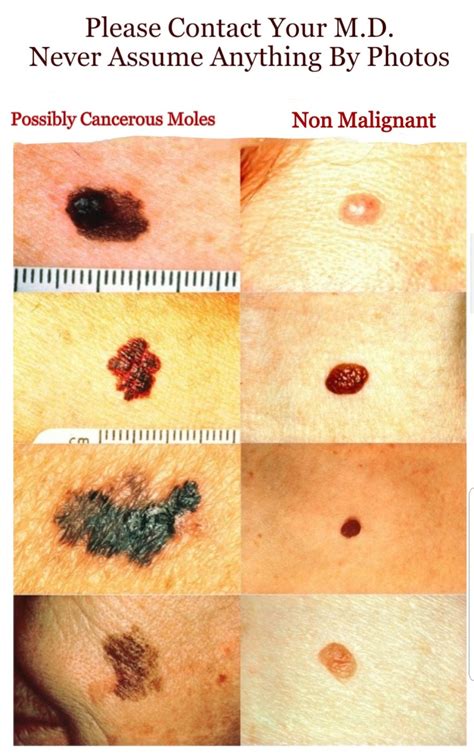 How To Check Your Moles For Skin Cancer Melanoma See Pictures Of Cancerous And Regular Moles