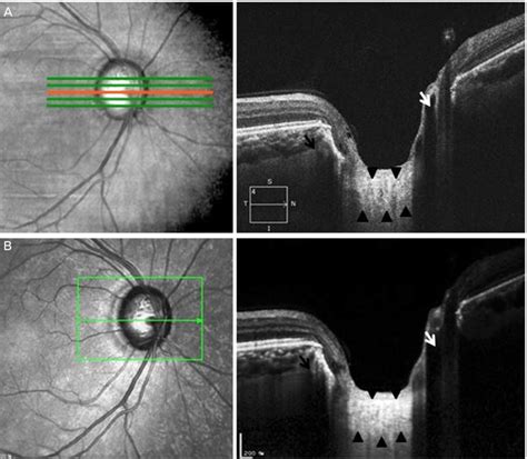 Optic Nerve Head Complex Of Cross Sectional Images Revealed Using