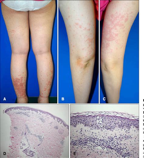 Figure From Pruritic Urticarial Papules And Plaques Of Pregnancy With