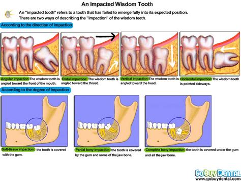Food debris and bacterial plaque can become trapped under the gum flap of the tooth, causing inflammation. Impacted wisdom tooth | Impacted wisdom teeth, Dental ...
