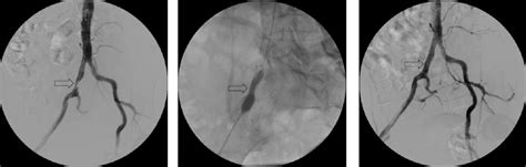 Iliac Artery Angioplasty And Stenting Vascular Centre
