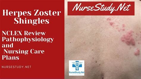 Herpes Zoster Shingles Nursing Diagnosis And Nursing Care Plan