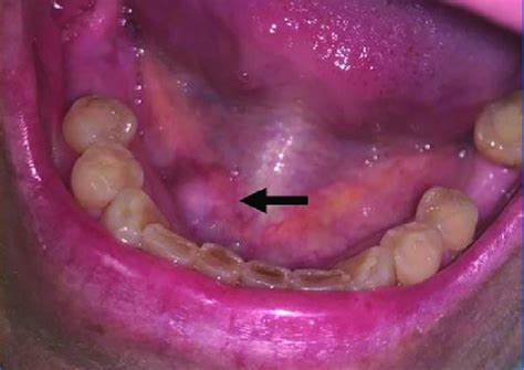Clinical Photograph Showing The Swelling In The Floor Of The Mouth