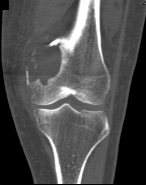 Fractured Aneurysmal Bone Cyst Femur Musculoskeletal Case Studies