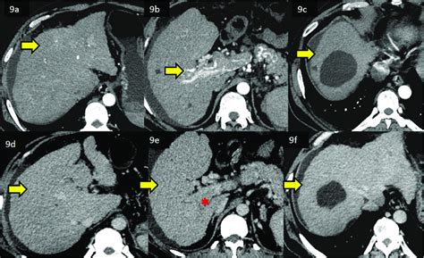 Triple Phase Cect Scan Of A Lirads 3 Observation In The Liver Without