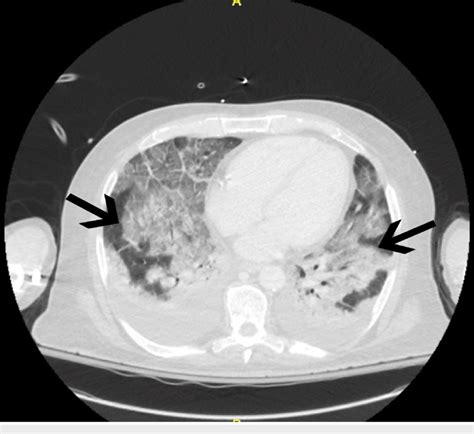 Ct Of Chest With Contrast Demonstrates Ground Glass Infiltrate And
