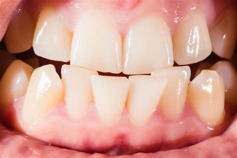 Causes Of Crooked Teeth Shinagawa Dental Blog