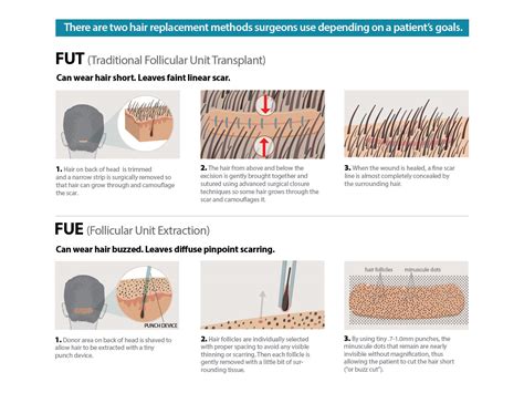 Follicular Unit Extraction Fue Hair Transplant In Walnut Creek San