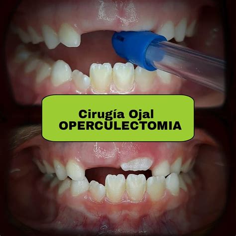 La Operculectomía También Consultorio Dental Odontocat Facebook