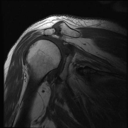 Subacromial Impingement Radiology Reference Article Radiopaedia Org