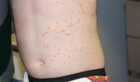 Skin Bumps On Children Dorothee Padraig South West Skin Health Care