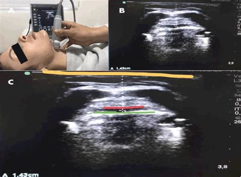 Development Of Ultrasound Diagnostic Test For Preoperative Airway