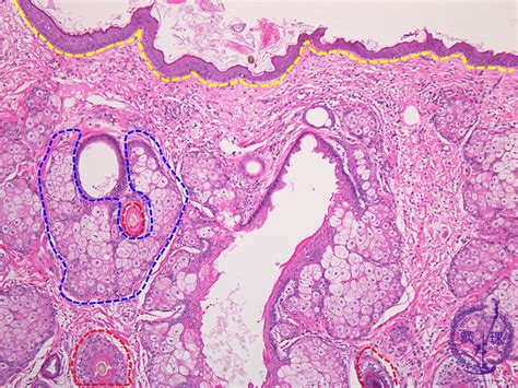 Female Genital Organs Ovarian Teratoma Dermoid Cyst Pathology