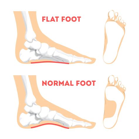 No Children Dont Magically Grow Out Of Flat Feet Treatment Is Key